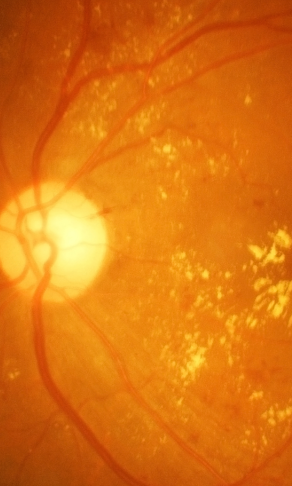 Retinal Degeneration - Doheny Eye Institute